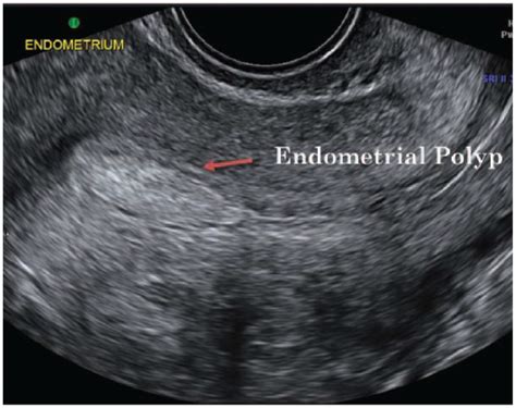 uterine polyp impact blood test|ultrasound for uterine polyps.